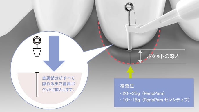 PerioPam – Narcohm Co., Ltd., Diagnostics