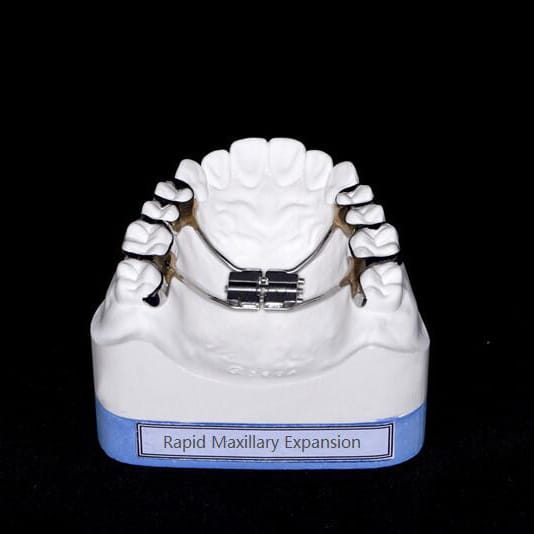 Rapid Maxillary Expansion – New Perfect Dental Lab, Intraoral Appliances