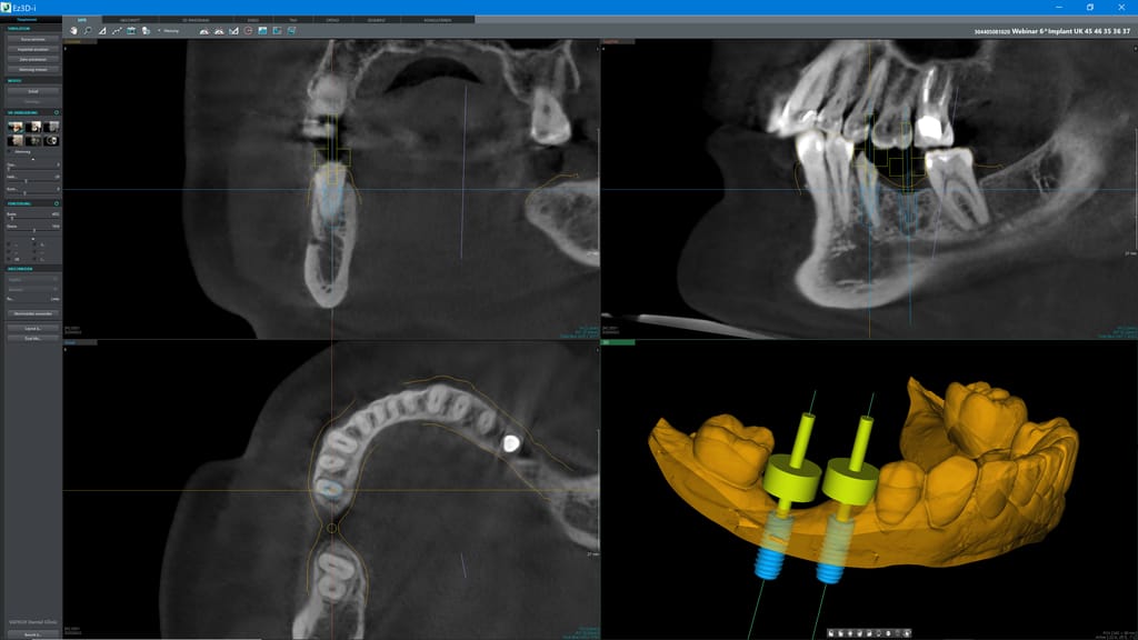 byzz® Ez3D-i – orangedental, CAD/CAM Software