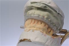 Perflex T-Crystal Thermoplastische Prothese