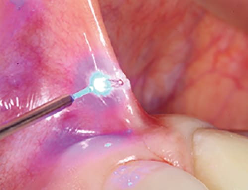 S3 Plus Supergepulstes Dental-Lasersystem Triple-Wellenlänge Pro 2.0 – Wuhan Pioon Tech. Co.,Ltd., Geräte