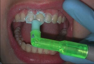2pro® Disposable Prophy Angle – Premier Dental, Prophylaxis Polishers