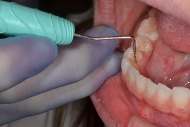 PremierAir® – Premier Dental, Probes & Diagnostic Instruments
