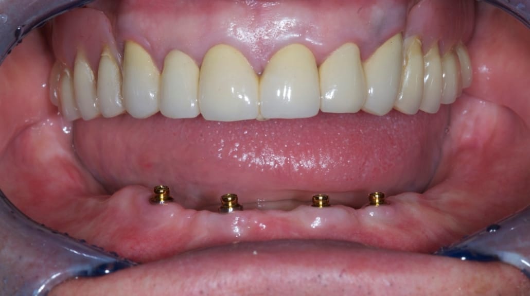 OT EQUATOR ATAČMENT: ZA SVE IMPLANT PLATFORME – Rhein 83 S.R.L., Abutments