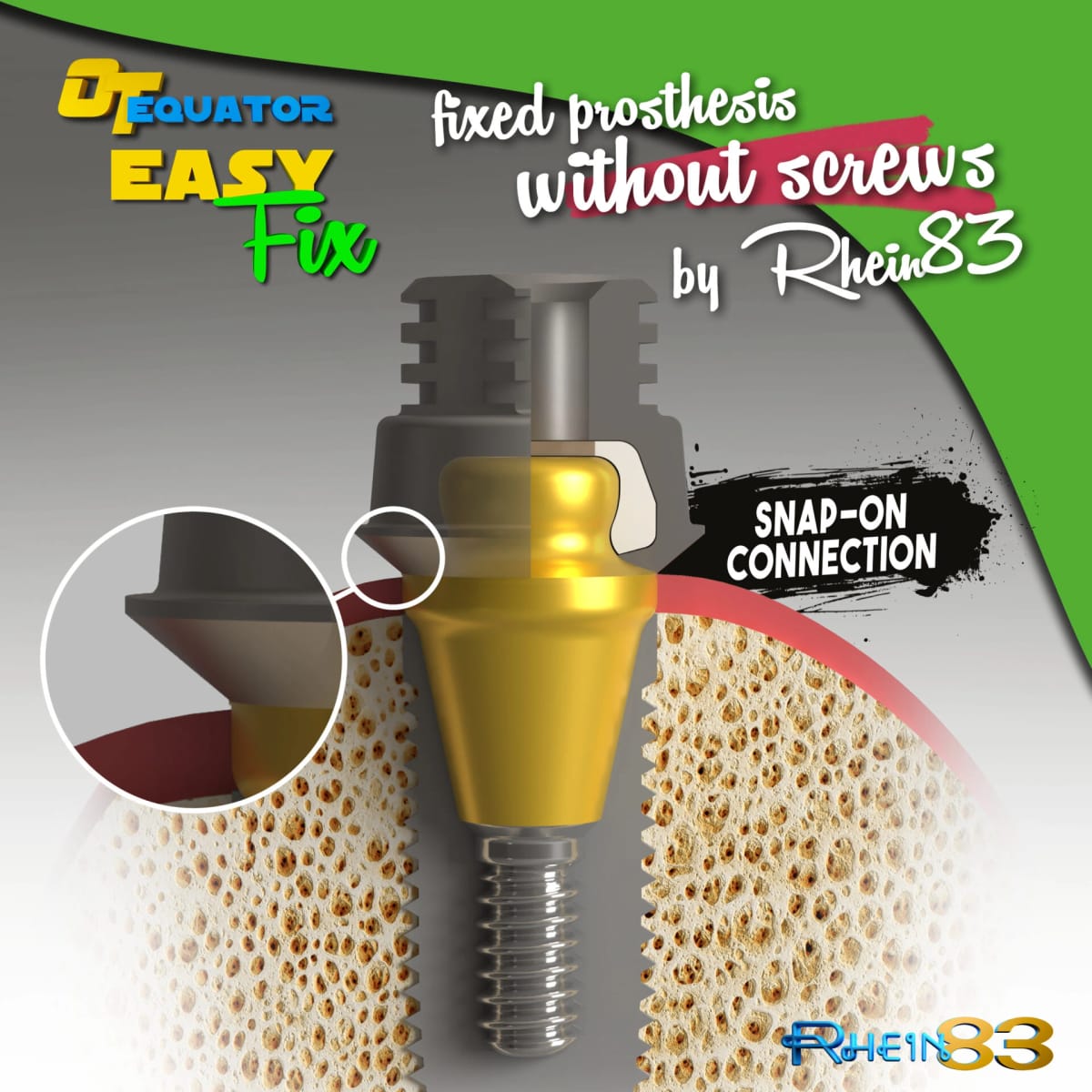 OT EQUATOR EASY FIX – Rhein 83 S.R.L., Implantology