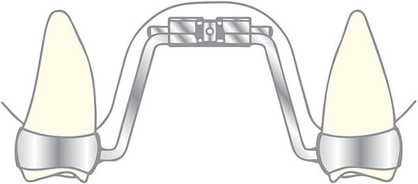 VECTOR® 600, Gaumennaht-Schraube 2524