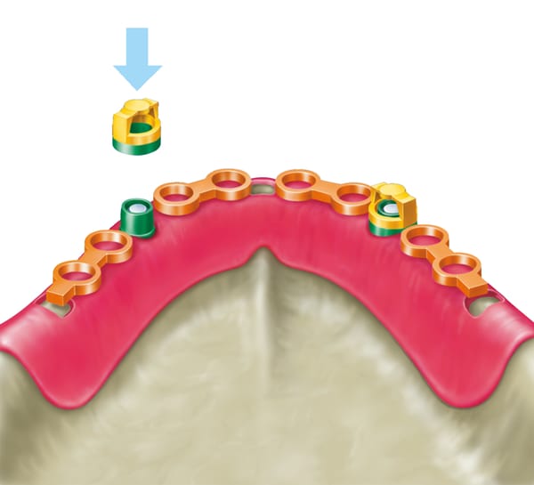 Base profiles for ball anchors