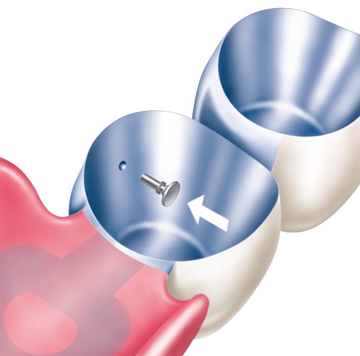 Tele-Fit – Servo-Dental, Geschiebe