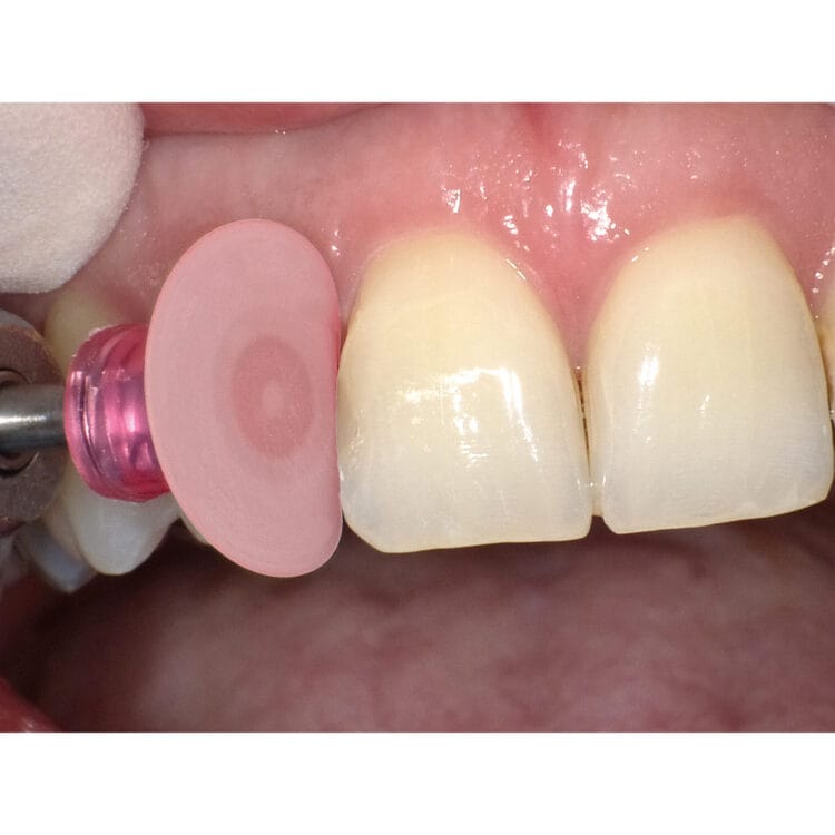 Super-Snap X-Treme – SHOFU DENTAL, Polishing Discs and Strips