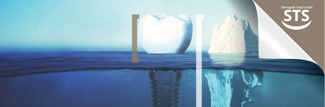 STS6: Digital/Konventionelle Prothese auf natürlicher Zahnwurzel – Sterngold Dental, LLC