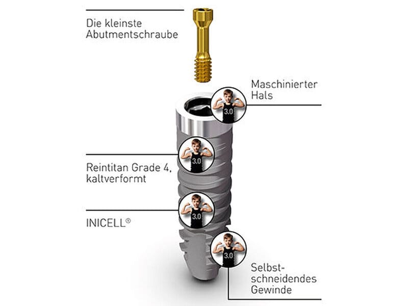 Element PF 3.0 – zm - Zahnärztliche Mitteilungen, Implants