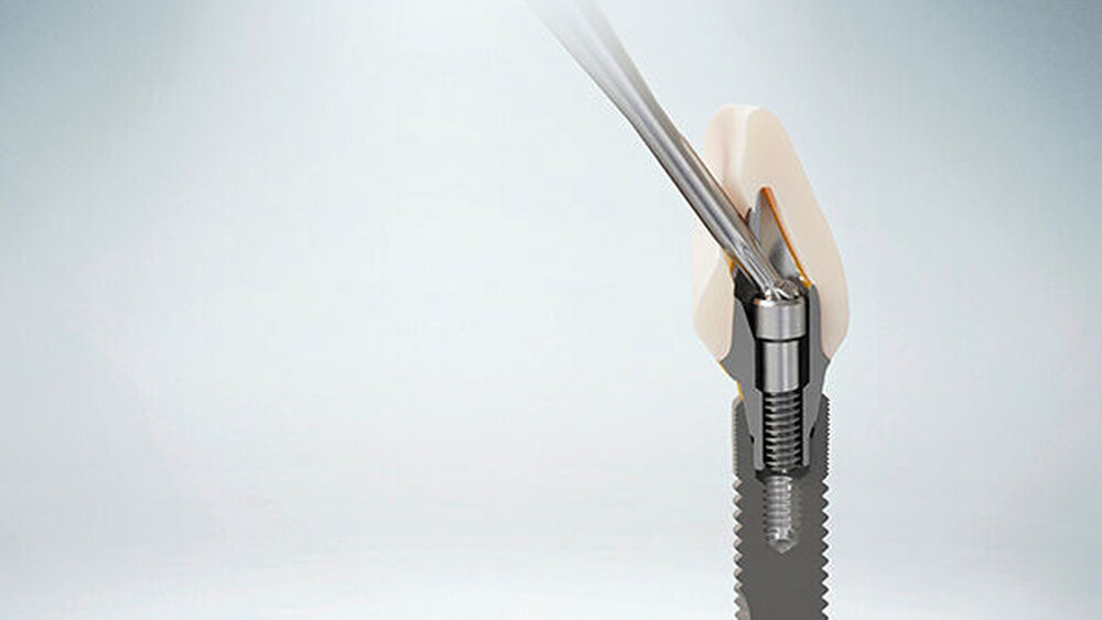 Atlantis CustomBase-Lösung mit anguliertem Schraubenzugang – zm - Zahnärztliche Mitteilungen, Implant Components & Abutments