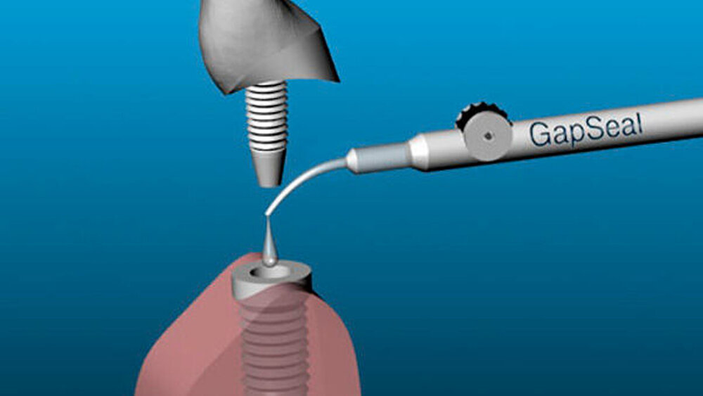 GapSeal – zm - Zahnärztliche Mitteilungen, Implant Components & Abutments