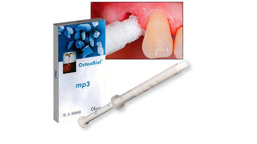 OsteoBiol mp3 – zm - Zahnärztliche Mitteilungen, Bone Graft Materials